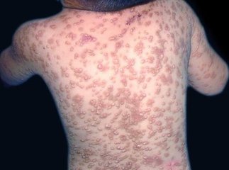哈尔滨皮肤病医院 荨麻疹      很多人都不了解荨麻疹,从而错过了治疗